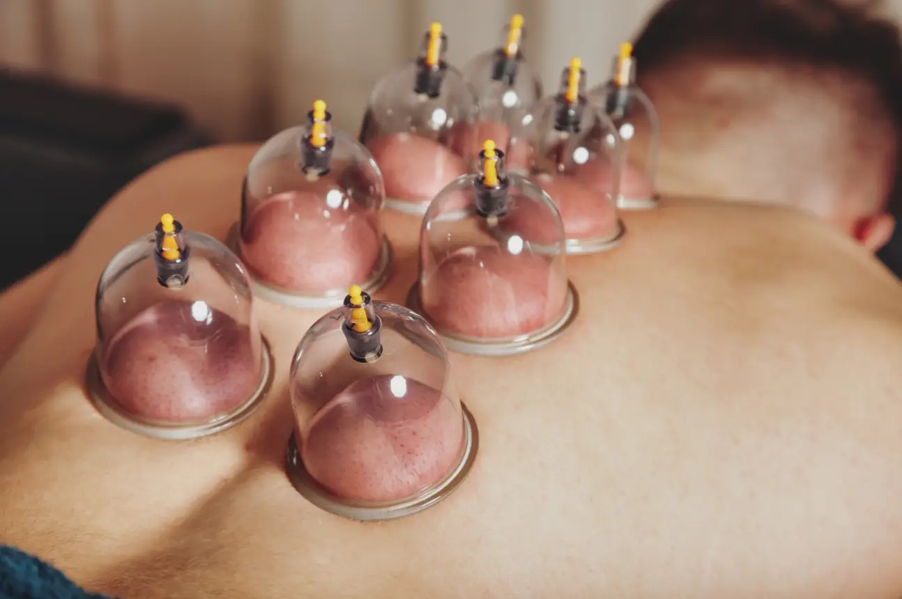 Wet cupping therapy in lahore